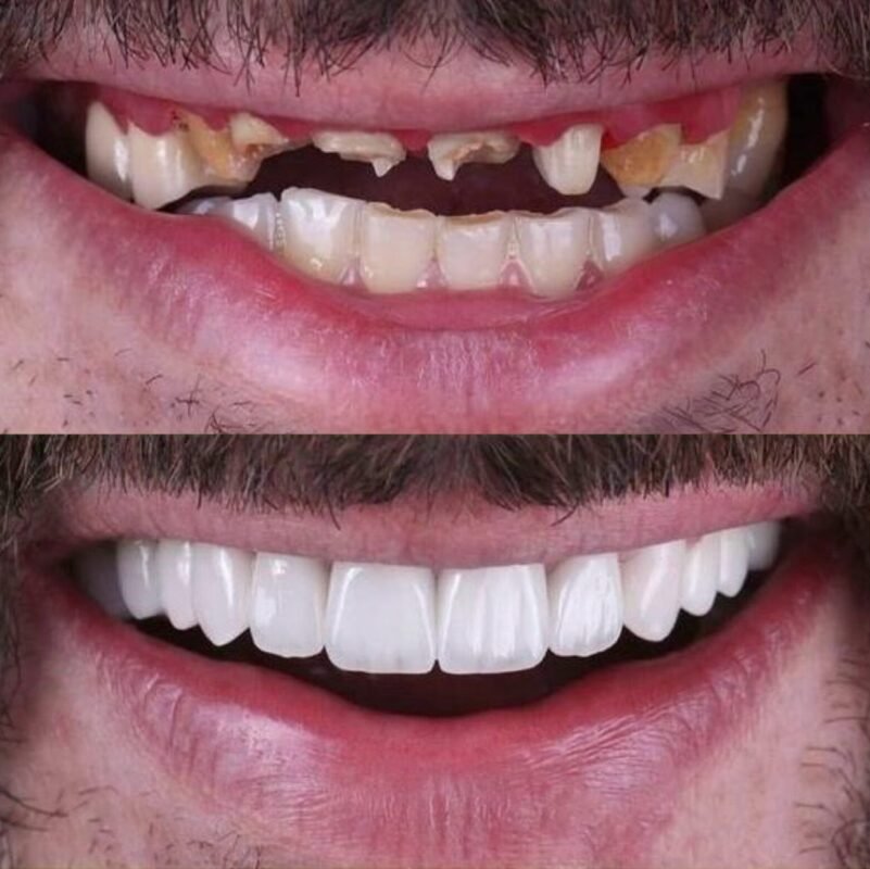 3M Lava Zirconia Crowns