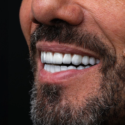 Patient displaying a flawless 8 teeth smile after getting veneers in Egypt