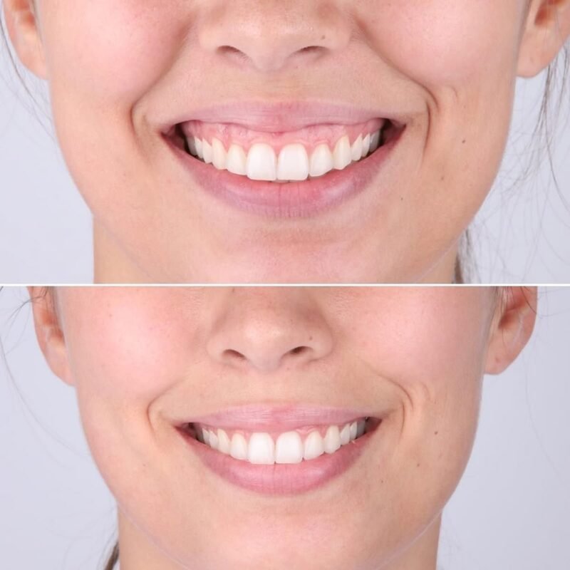 Non-Invasive Gummy Smile Correction in Egypt