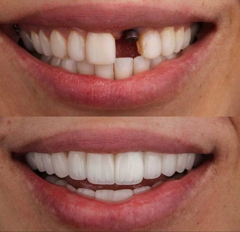 Premium Dental Implant with Crown in Egypt | Save 80%